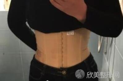 星群医疗整形医院流体动力腰部吸脂案例分享,产后减肥当辣妈！