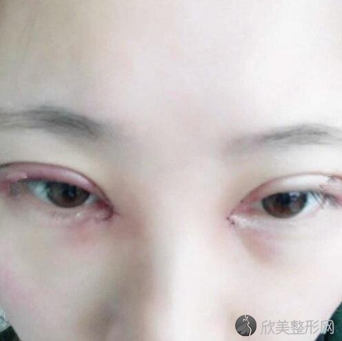 张晓棠医生眼部综合整形手术案例恢复过程一览,内附恢复效果图！