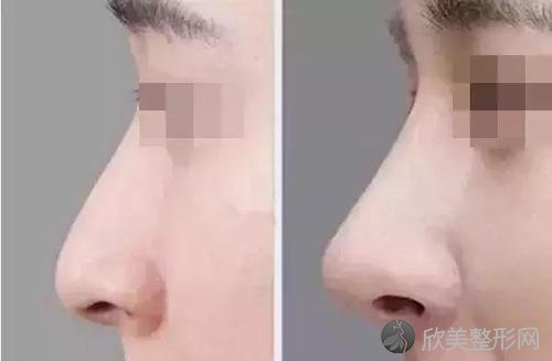 自体脂肪隆鼻会变宽吗 那存在什么样的危害呢 欣美整形 自体脂肪隆鼻会变宽吗 那存在什么样的危害呢 欣美整形