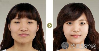 兰州嘉琳田海峰介绍做下颌角手术的特点和安全性~让你瞬间变成美丽瓜子脸
