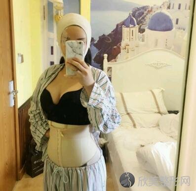 环形吸脂减肥手术效果如何？看完真实案例及术后效果图分享,难怪被称为小蛮
