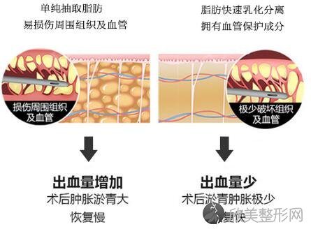 环形吸脂减肥手术效果如何？看完真实案例及术后效果图分享,难怪被称为小蛮
