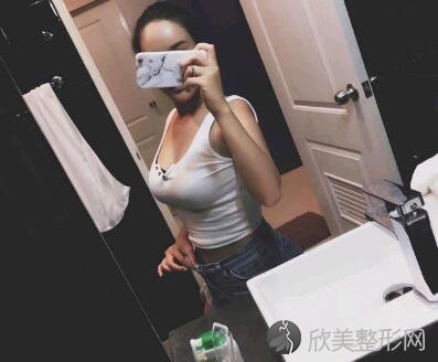 环形吸脂减肥手术效果如何？看完真实案例及术后效果图分享,难怪被称为小蛮
