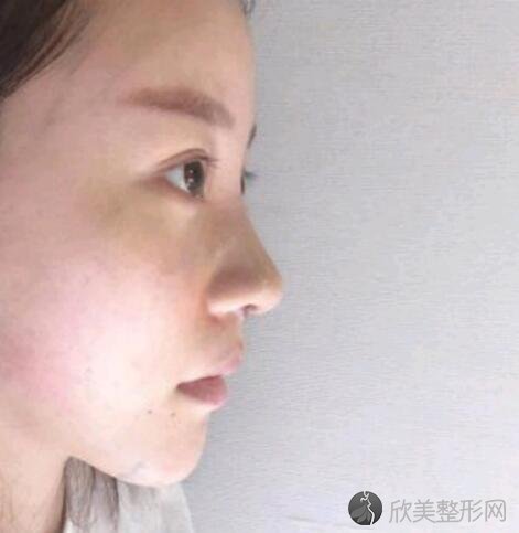 瑞兰2号玻尿酸丰下巴案例效果图分享 颜值提高看得见 欣美整形