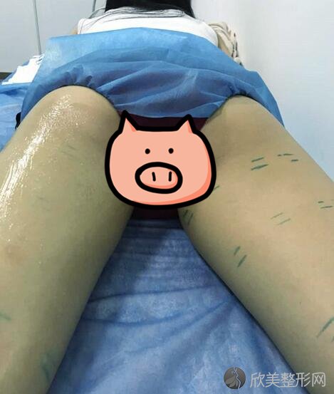 青岛陈震宇吸脂案例分享,拥有一双漫画腿的感觉真不错！