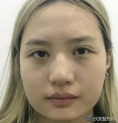 双下巴吸脂是真实案例渲染 侧脸简直无敌！