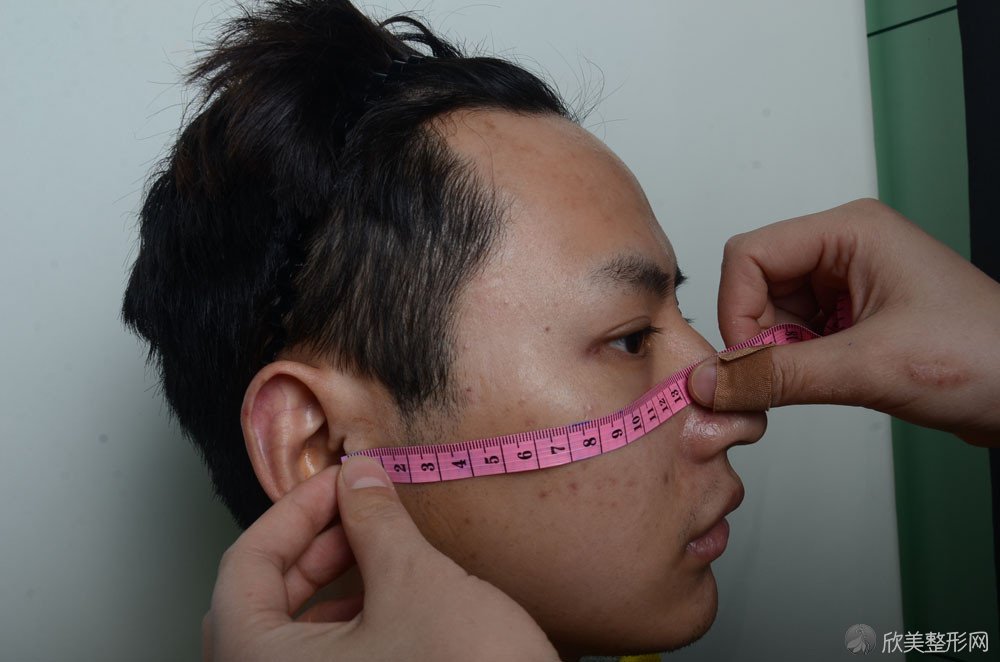 男性下颌角整形真人案例分享,颜值一路飙升