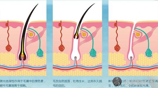 重庆星宸整形医院讲述激光脱毛的特点和激光脱毛影不影响出汗?