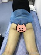 大腿粗的流体动力吸脂经验 术后能不能化身筷子腿…