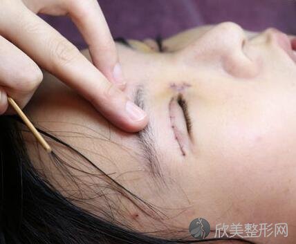 北京京民割双眼皮的经验 老医生做的很仔细！