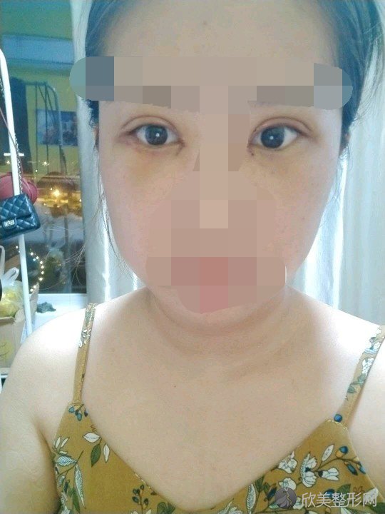 做双眼皮之后