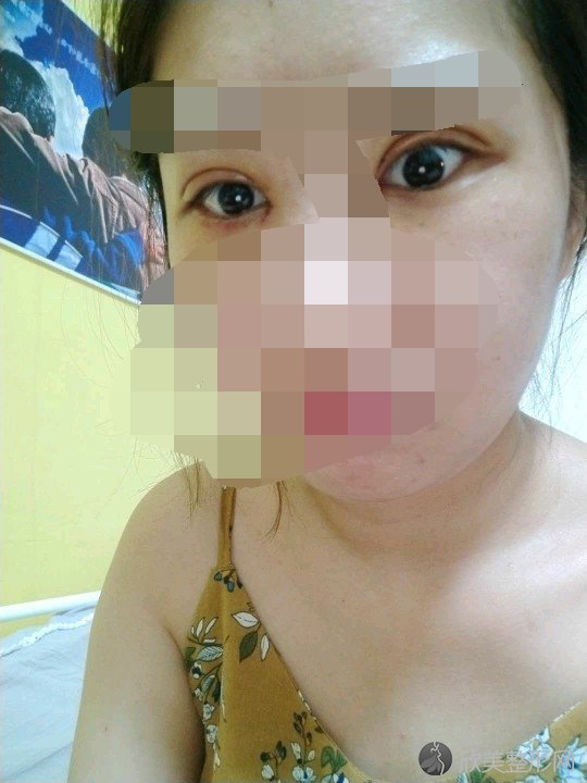 做双眼皮之后