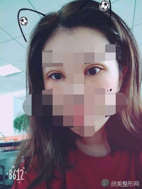 做双眼皮之后