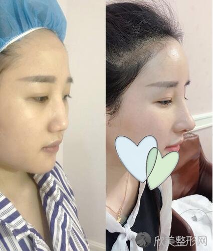 [案例]韩国医生做鼻子怎么样？手术后108天还喜欢