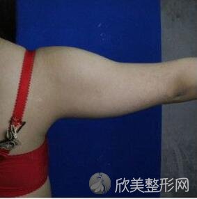 重庆吸脂案例:重庆当代整形医院手臂吸脂！