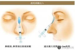 北京玻尿酸隆鼻价格是多少？