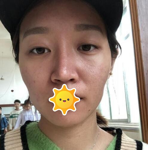 八大处张超面部脂肪修复好吗?隆鼻术后三个月真实野生反馈