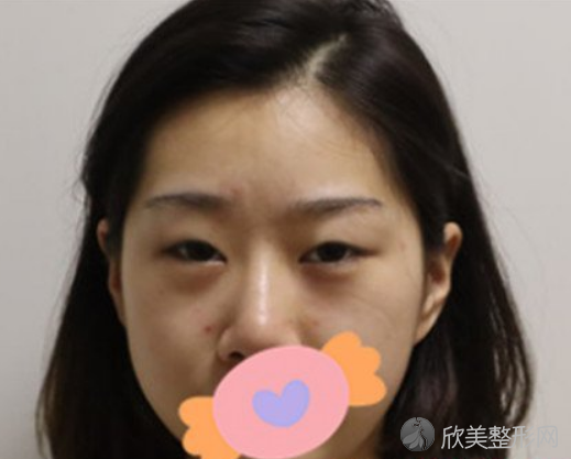 重庆美仑美奂整形美容医院双眼皮案例