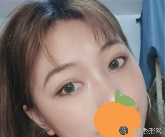 重庆联合丽格整形医院双眼皮案例