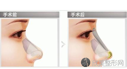 刘野医生科普：耳软骨、肋软骨、鼻中隔软骨的区别和隆鼻谣言有哪些？