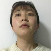 丰下巴前后对比效果图