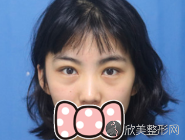 西京医院美容整形科双眼皮修复真人案例展示
