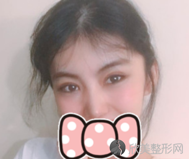 西京医院美容整形科双眼皮修复真人案例展示