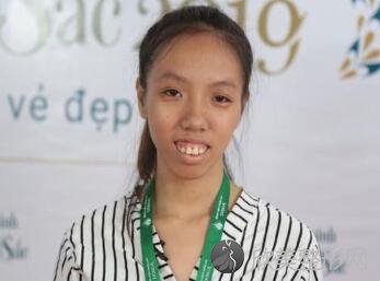 越南龅牙妹Nhu Huyen如何逆袭成功？牙齿整形案例分享及前后前后对比