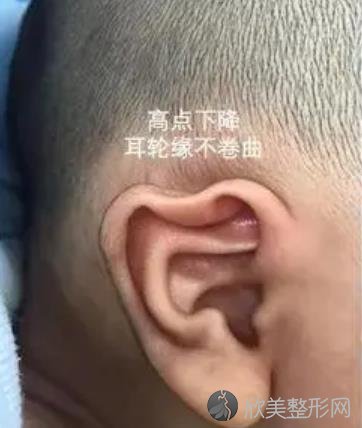 耳朵整形