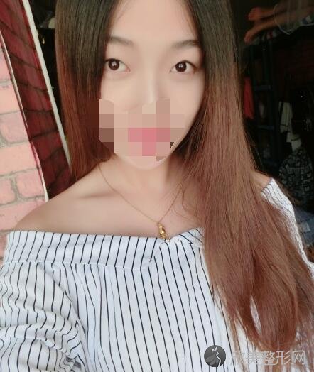 双眼皮术前