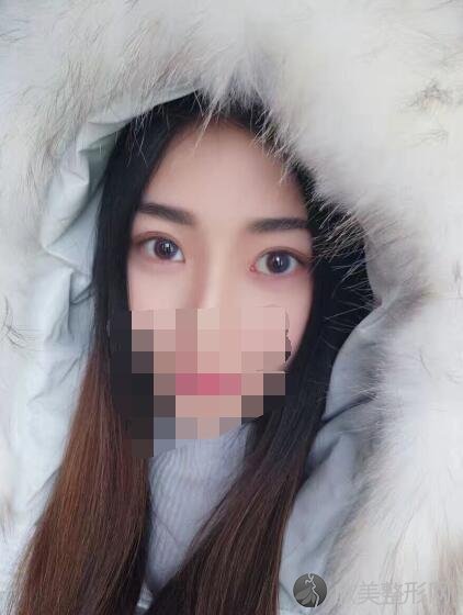 双眼皮术后20天