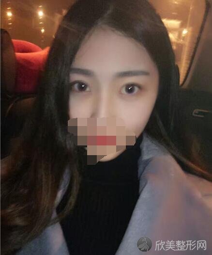 双眼皮术后30天