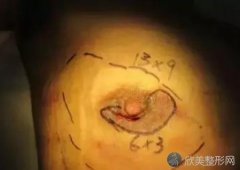 乳头矫正手术会后悔吗？