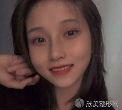 广州壹加壹美容医院鼻部多项案例