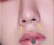 缩鼻翼前后对比效果怎么样？好不好？