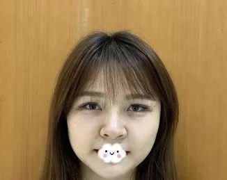 北医三院赵旬光子嫩肤怎么样?玻尿酸面部填充顾客术后反馈案例-收费标准