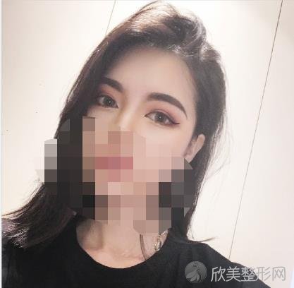 武汉悦秀医疗美容医院做双眼皮之后