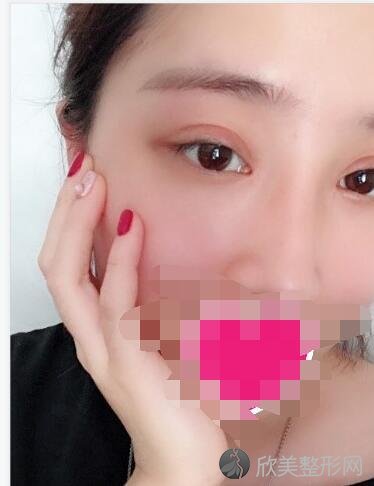 双眼皮术后20天