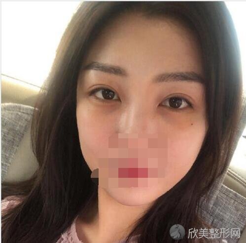 祛眼袋术后20天