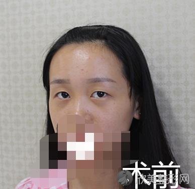成都心悦容双眼皮之前