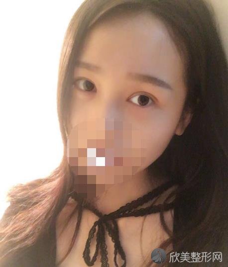 成都心悦容双眼皮之后