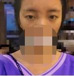 成都美极双眼皮之前