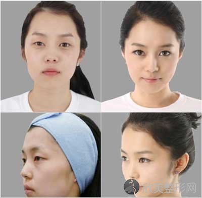 北京俯大整形的王倩医生做双眼皮的技术怎么样呢？