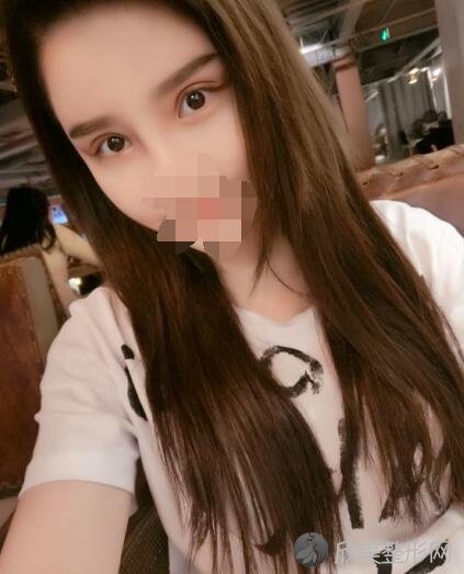 双眼皮术后20天