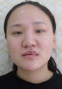 腭裂一二三度图片，附腭裂整形修复案例