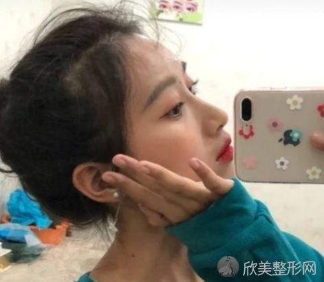 中国鼻整形医生排名分享附隆鼻真人案例