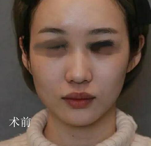 北京304陈敏亮主任怎么样?注射术前术后图