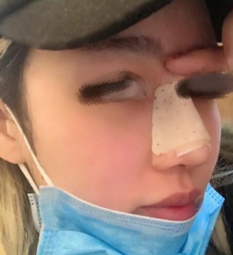 北京304陈敏亮主任怎么样?注射术前术后图