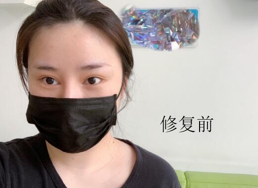 北京安贞李斌斌双眼皮修复案例怎么样?隆鼻术前术后图