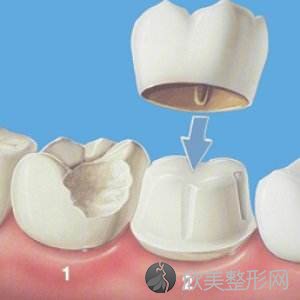 烤瓷牙的修复范围有哪些